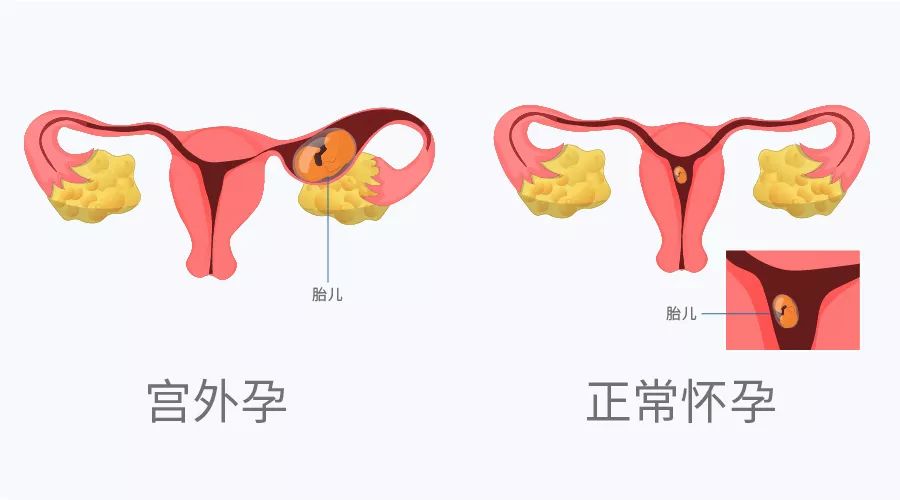 宫外孕能超过两个月吗？